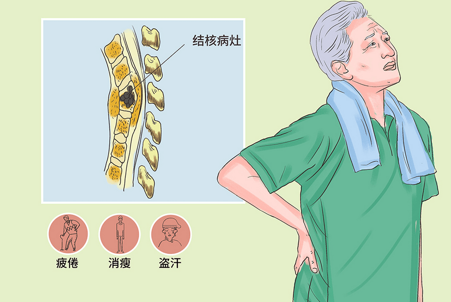 背着妈妈来看病的女孩笑了_治疗_胸椎_脊柱
