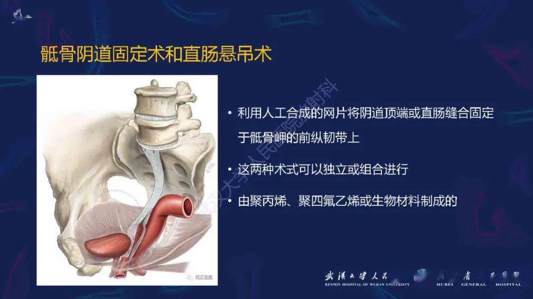 阴道骶骨固定术和直肠悬吊术后影像评估