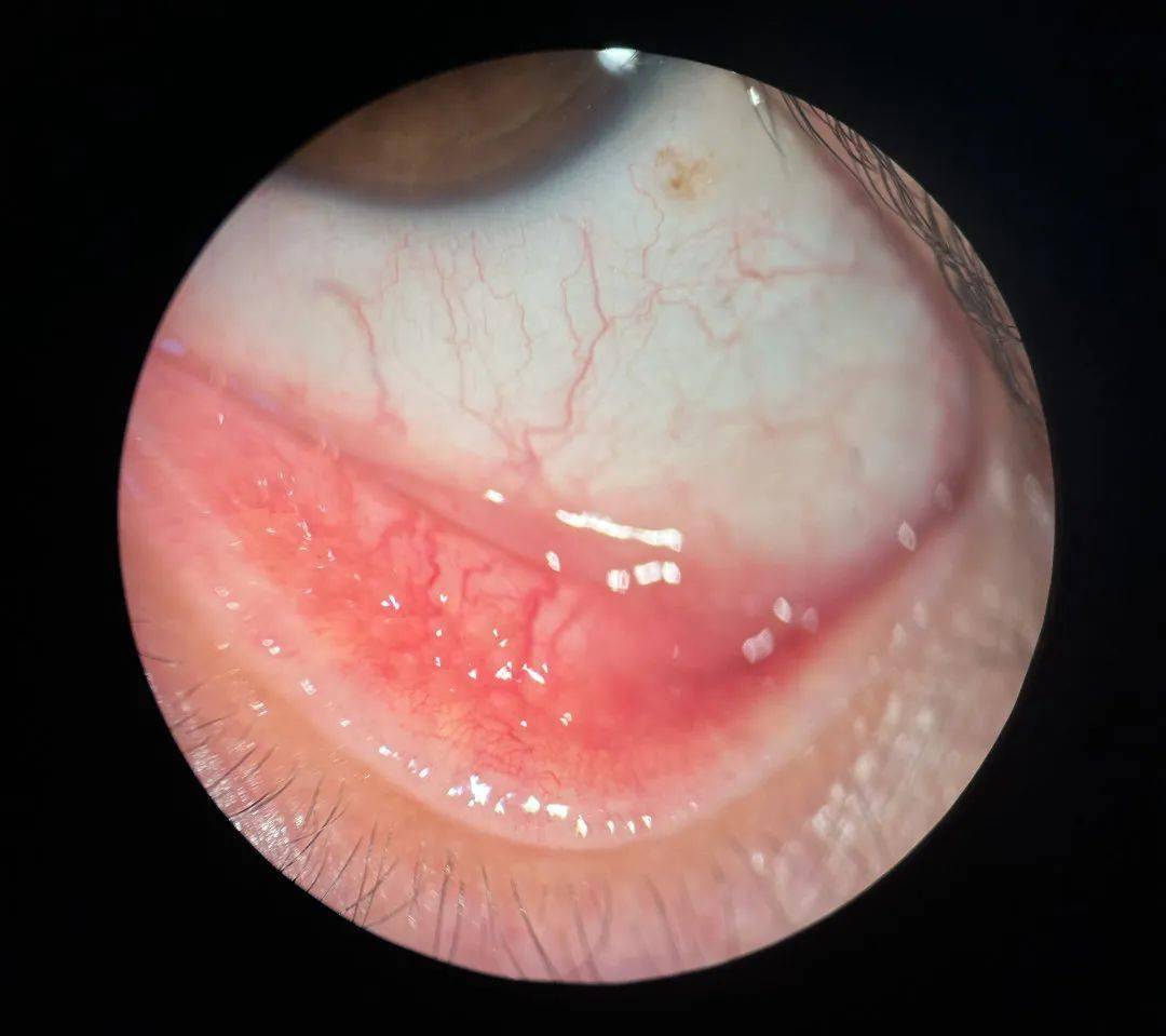 救我!我想把眼珠子抠出来!"入春后,你中招了吗?_杭州_过敏性_症状
