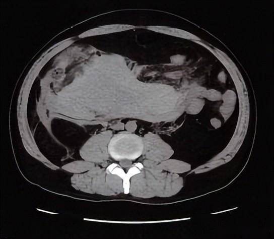 腹腔出血ct图片图片