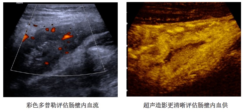 超聲不能檢查腸道?錯!