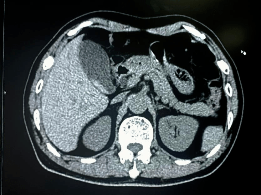 类圆形或多角形;ct值在40hu以下,变换体位结石位置有变动,少数与胆囊