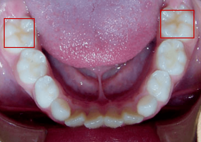 齿是不经历换牙而直接萌出,其中有4颗在6岁左右萌出,因此被称为六龄