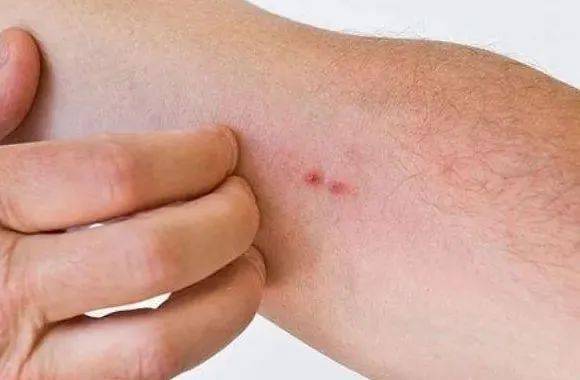 【科普】常见引起皮肤病的螨虫有哪些?_寄生_疥螨_患者