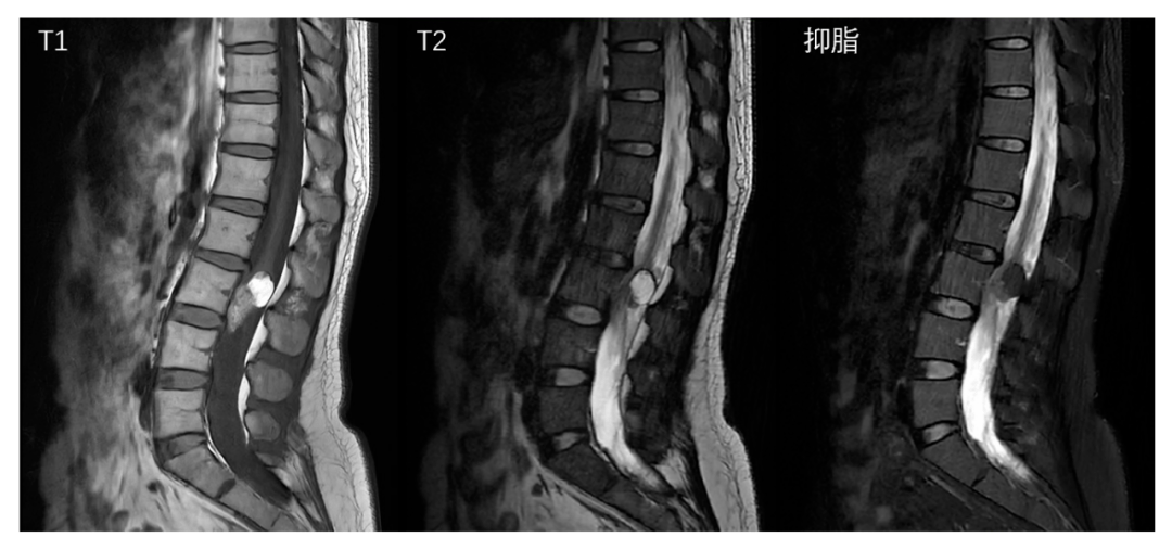 腰椎增强mr(图1)提示:腰3椎管内占位,考虑脊髓圆锥远端或终丝脂肪瘤