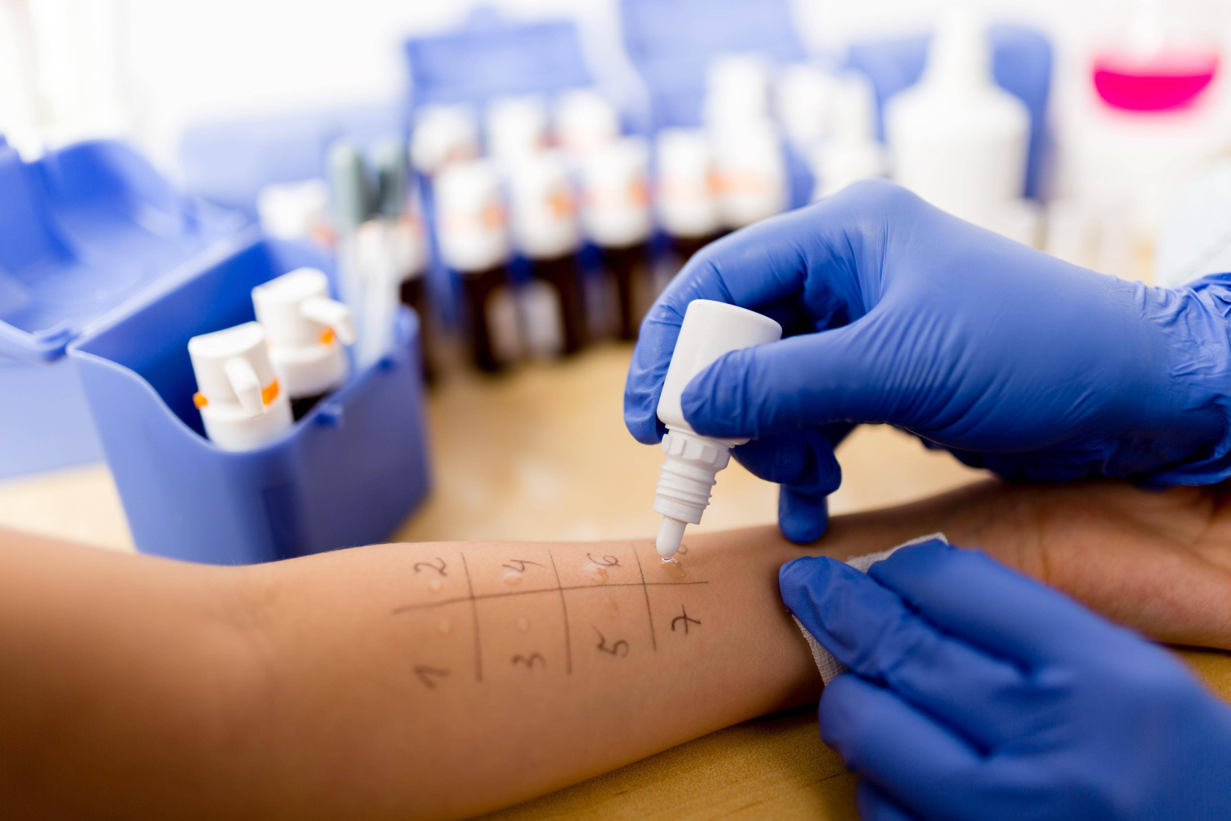 目前,临床常用的花粉过敏原检测方法包括:皮肤点刺试验(圆柏,杨树