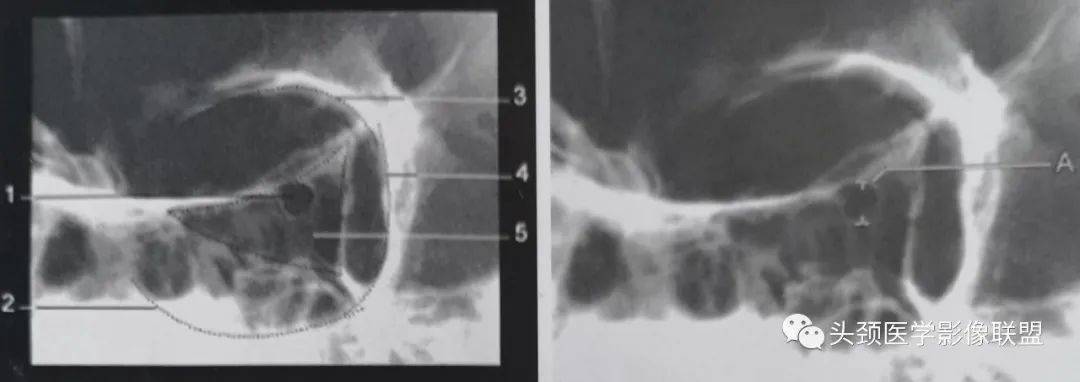 眼眶解剖(x线/ct/mri)和常见变异及误判_mm_眼球_直径