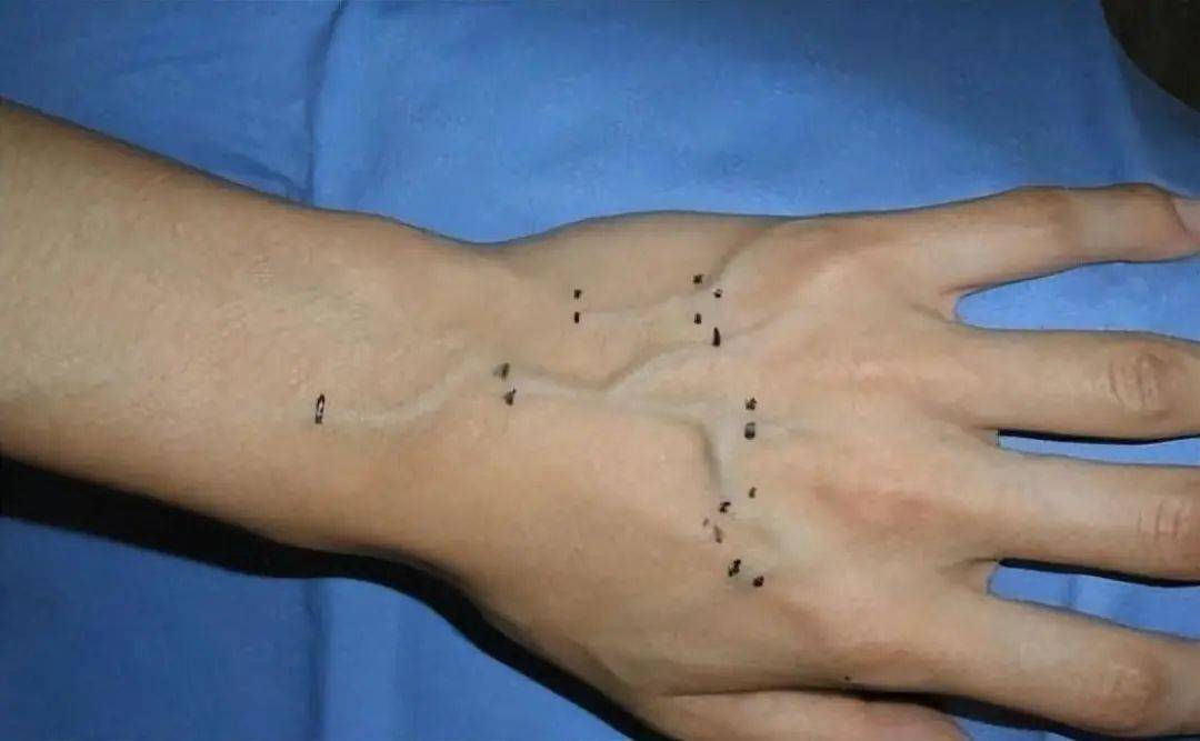 青筋的出现代表了什么?_血管_运动_说法