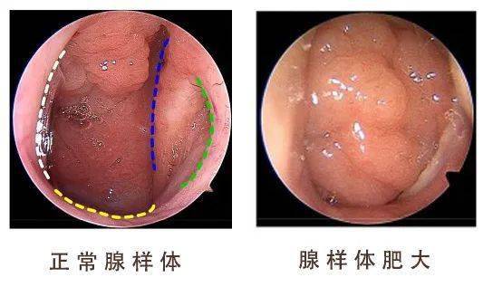 医生常常根据腺样体阻塞鼻后孔的程度,来判断腺样体的肥大程度,堵 1/4