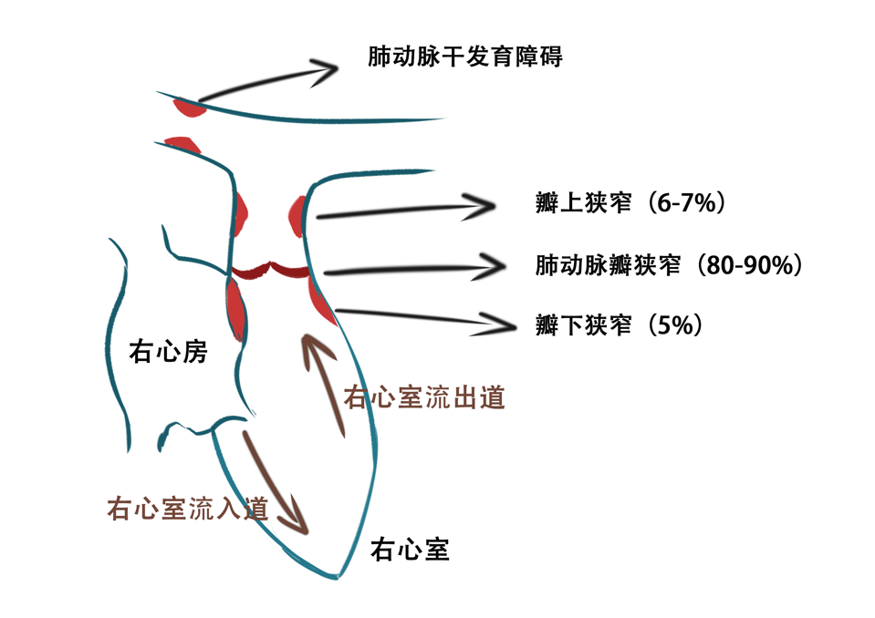 肺动脉瓣狭窄图片图片