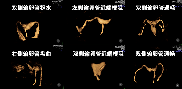 涿州市医院生殖医学科子宫输卵管四维超声造影上线啦!_宫腔_检查_盆腔