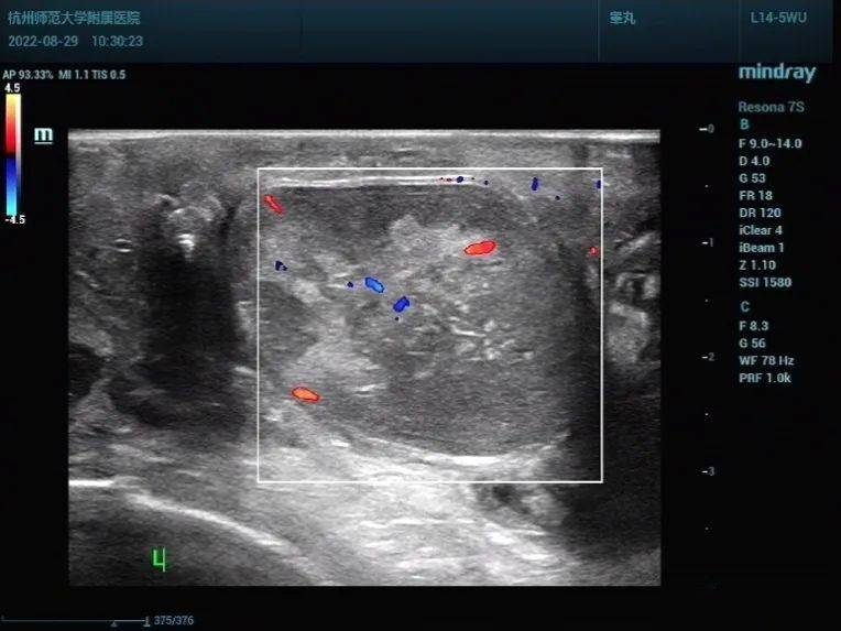 附睾超声测量图图片