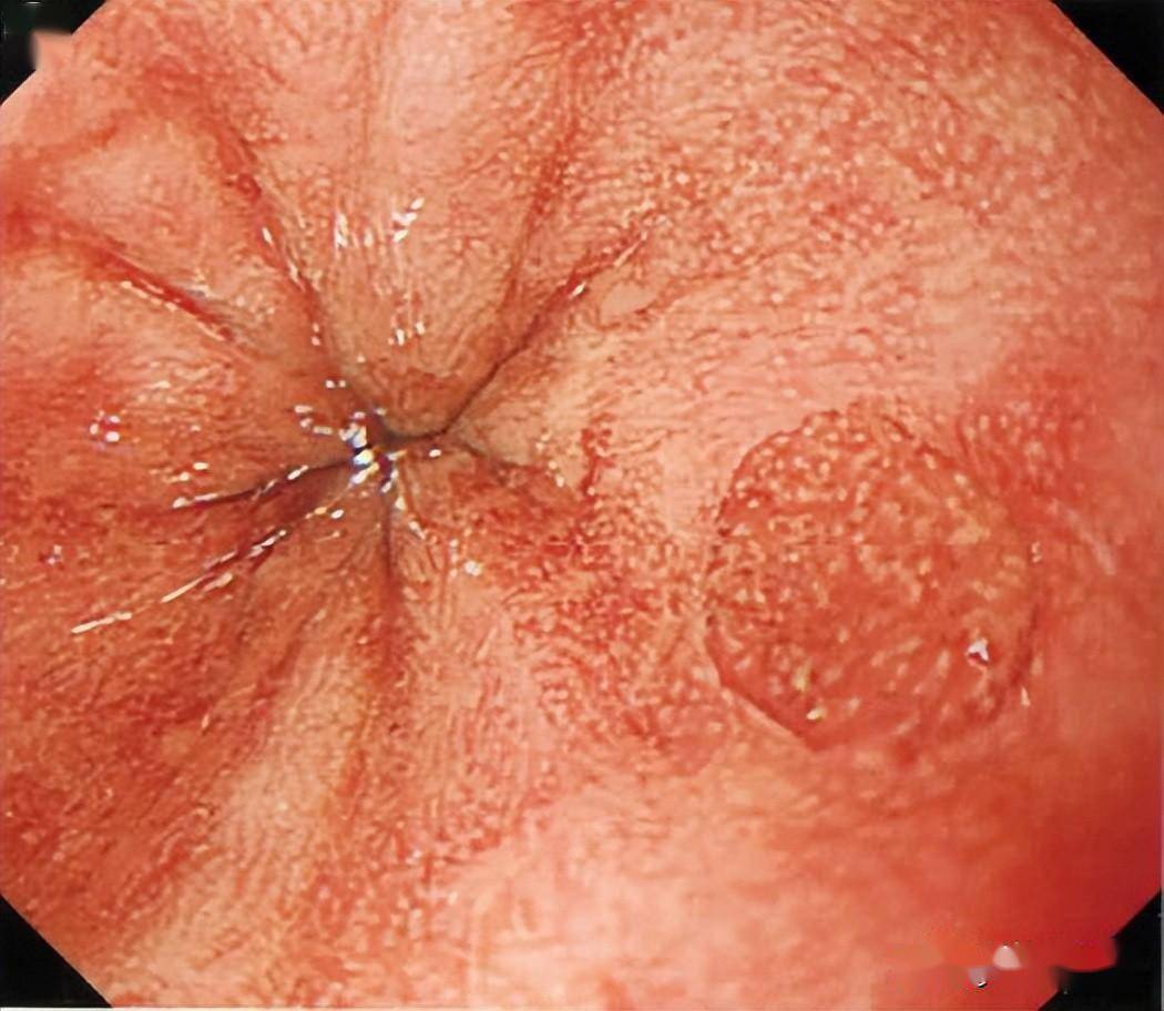食管胃粘膜异位症图片