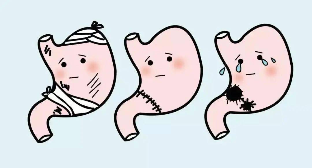 热点聚焦 | 胃癌术后腹胀难受,让厚朴排气合剂帮助及时"排气"_张大爷