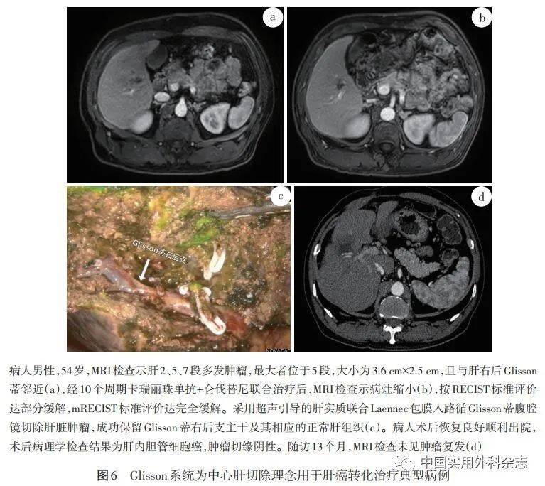 肝脏glisson鞘水肿图片