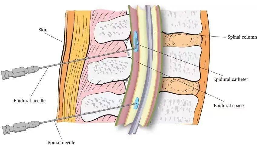 『阻力消失法』确定硬膜外腔位置后,单次注射硬膜外阻滞技术风靡欧洲