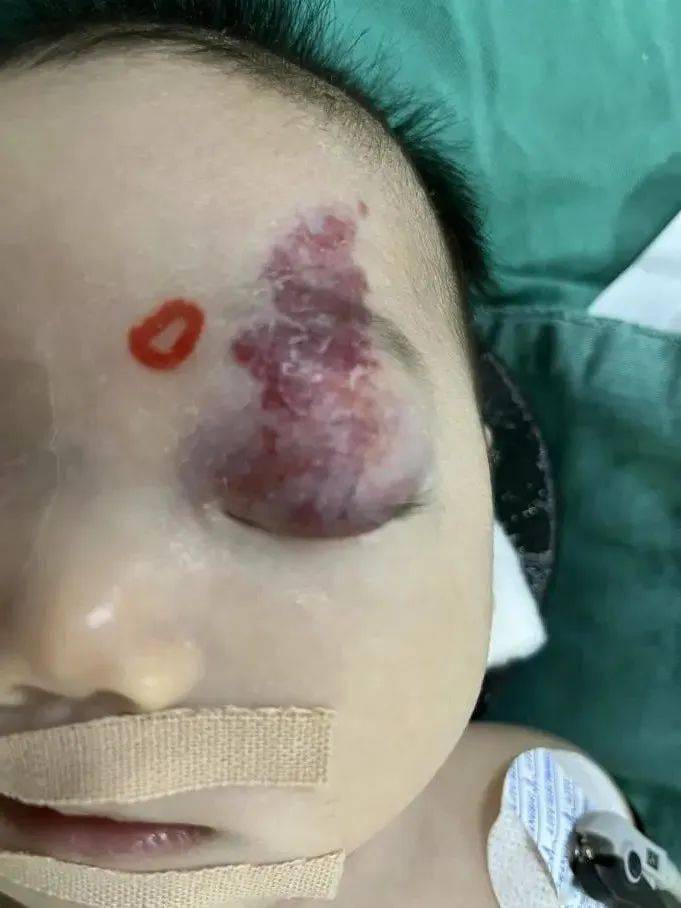 良性肿瘤不用管?2月大女孩用实际经历写出答案_治疗_儿童_胡靖