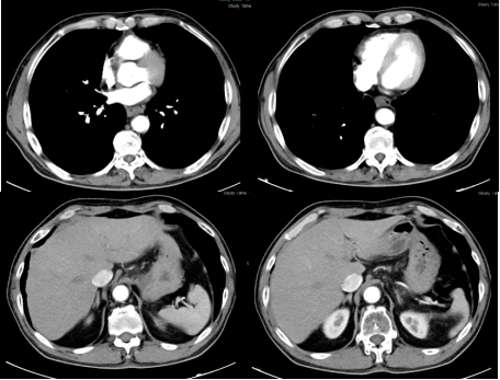 【医食无忧·艾赋新生】强效安全,拖尾效应显著,卡瑞利珠单抗为食管癌