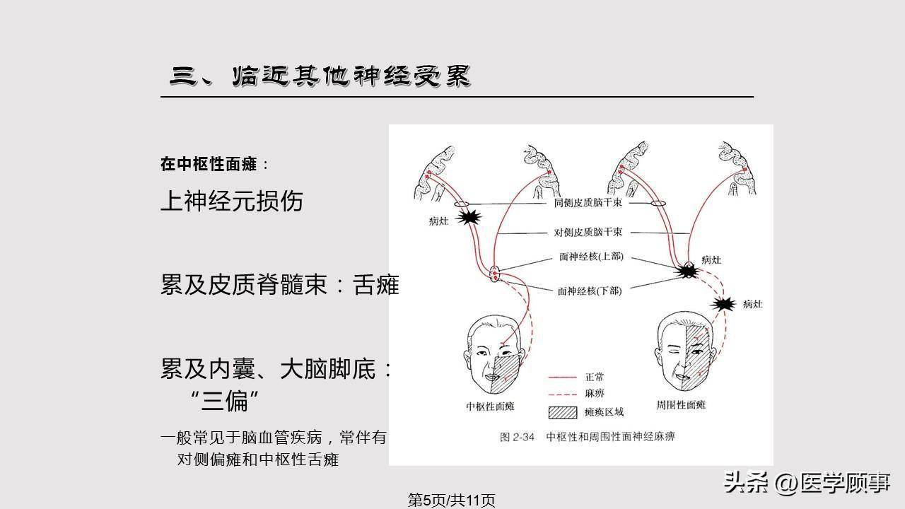 观评估面神经麻痹的分级,可用于评估预后,指导临床治疗,取得好 的临床