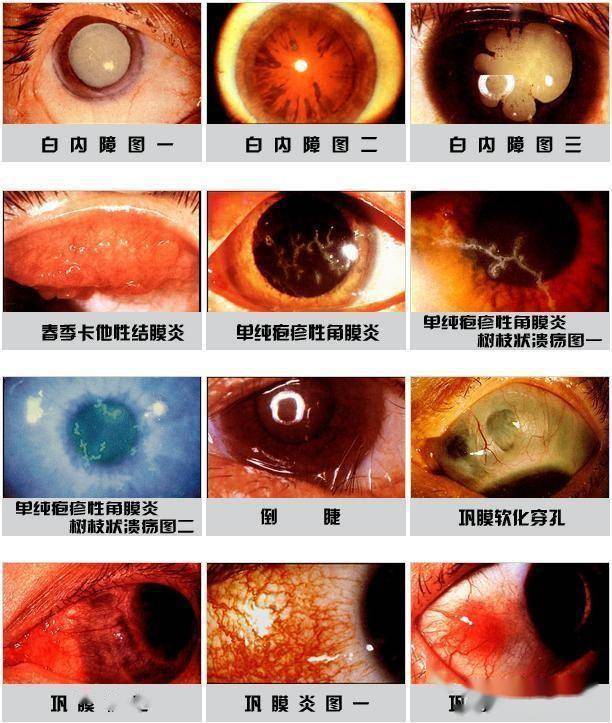 眼病的种类及症状图片图片