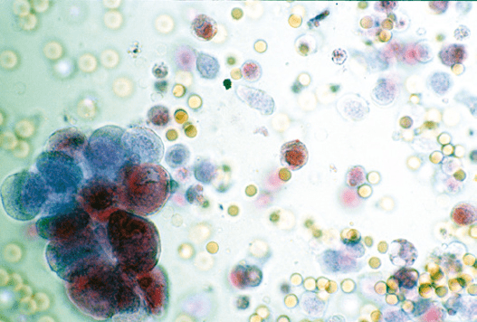 最新资料整理的尿检图谱:33张图片展示尿液中的上皮细胞_chew_来自