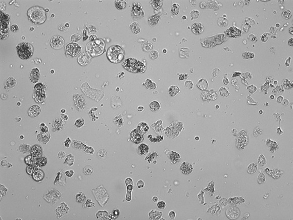 最新资料整理的尿检图谱:33张图片展示尿液中的上皮细胞_chew_来自