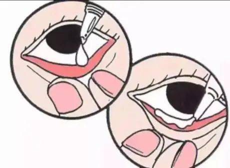 另一只手挤压眼膏管尾部,使眼膏呈线状溢出,将约1cm长的药膏挤进下