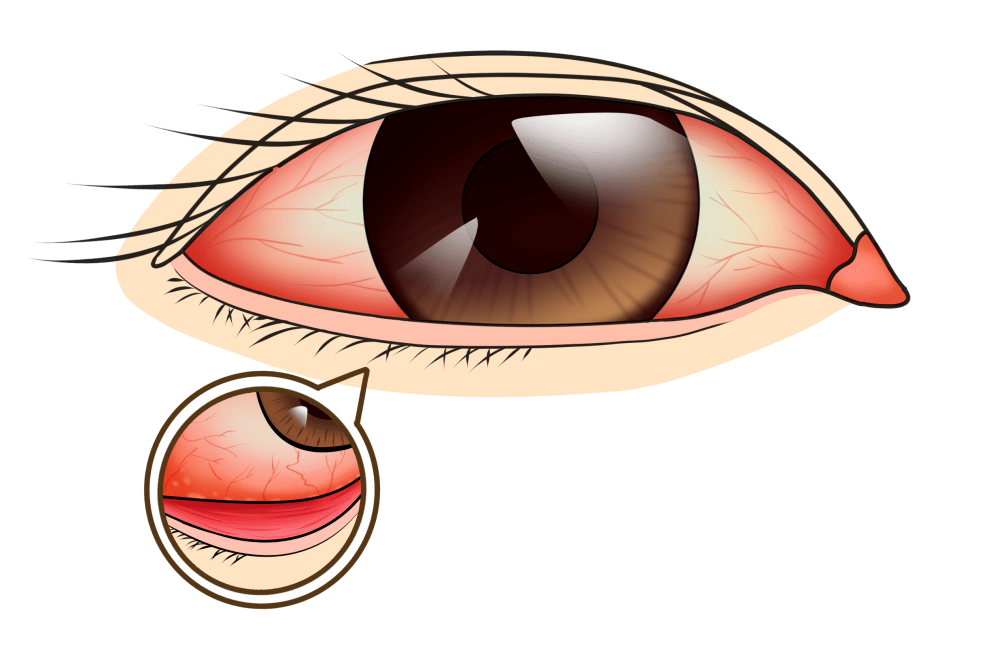 过敏,红眼病,结膜炎或其他类型的炎症,也会刺激眨眼反射.