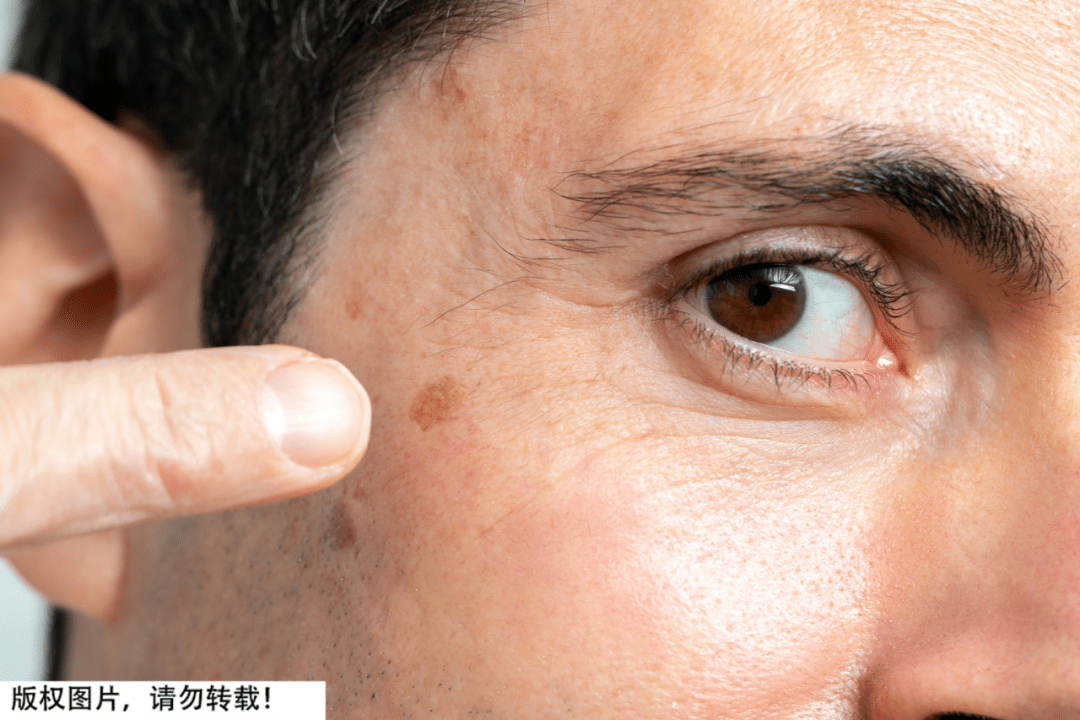 过去被射线照过的皮肤或陈旧疤痕发生变化,出现破溃伴有分泌物,出血等