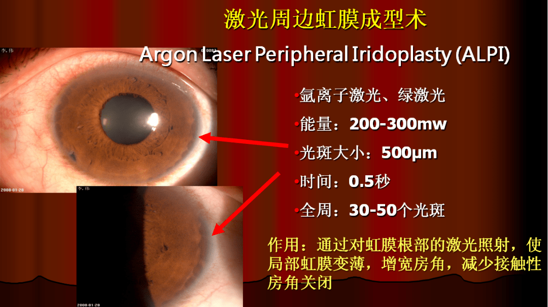 激光周边虹膜切除术图片