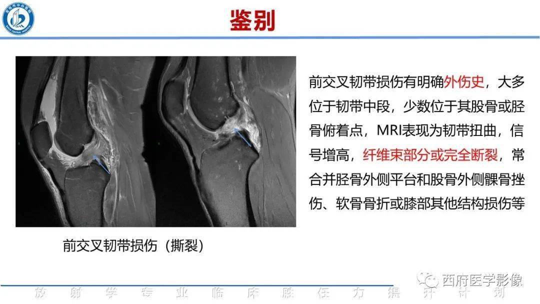 前交叉韌帶粘液樣變性影像診斷_平臺_鈣化_綜合徵