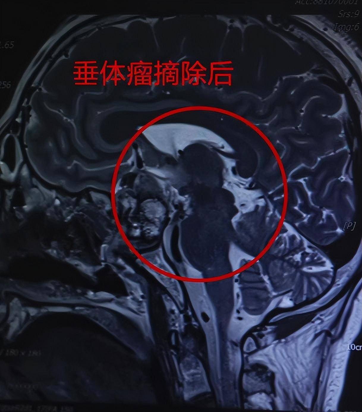 还有一些患上生长激素型垂体瘤的患者,会变得肢端肥大,面部丑陋,即使