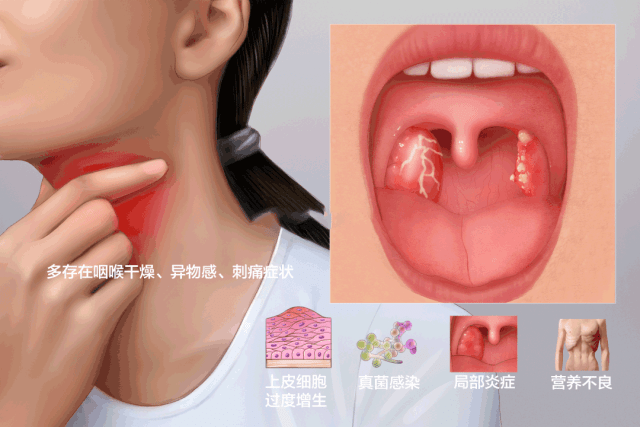 扁桃体炎就是喉咙痛吗?这些危害要警惕