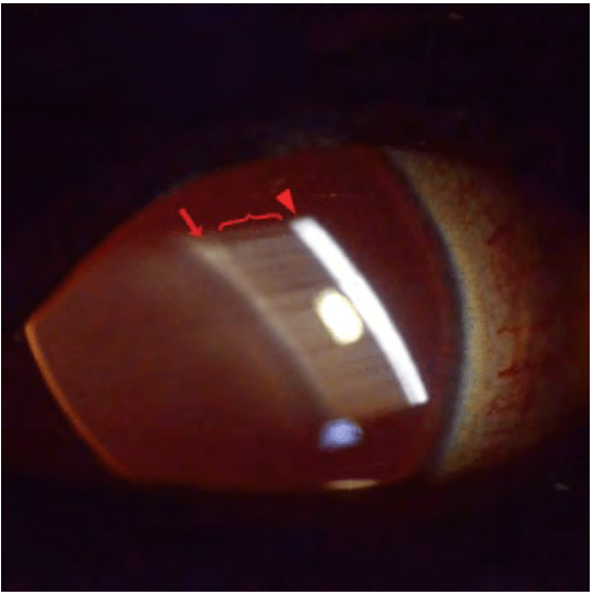 然而,没有房水闪辉并不表示没有葡萄膜炎→闪辉的严重程度与葡萄膜