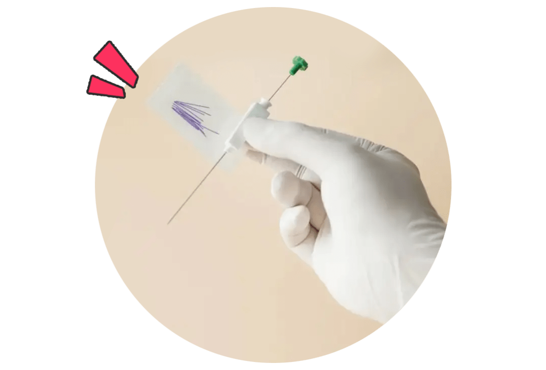 穴位埋线是针灸技术的延伸和发展,穴位埋线减肥的原理是把安全可吸收