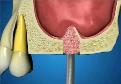 种牙上颌窦提升全过程图片