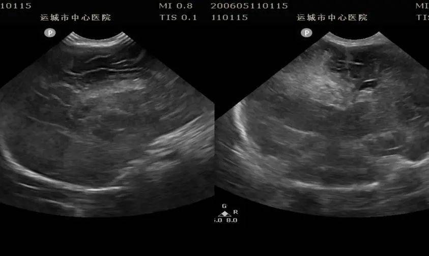 「 小儿颅脑超声」之新生儿脑实质出血