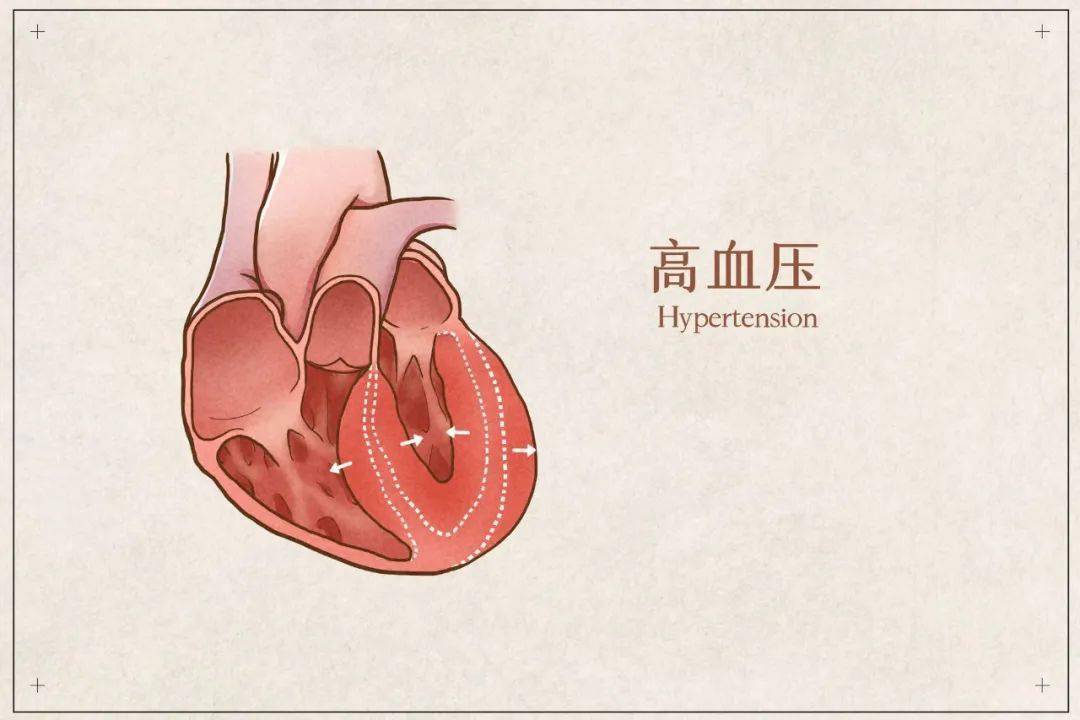 疾病预防 高血压遇上高气温