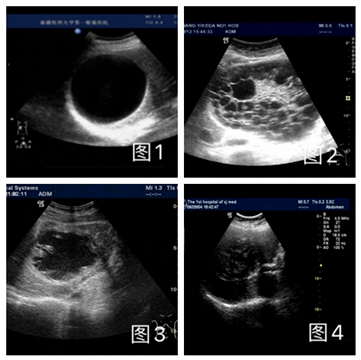 图3肝包虫囊肿超声常见的四个类型:1,单纯囊肿型 2,多子囊型3,内囊