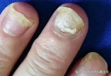 了解灰指甲啥样