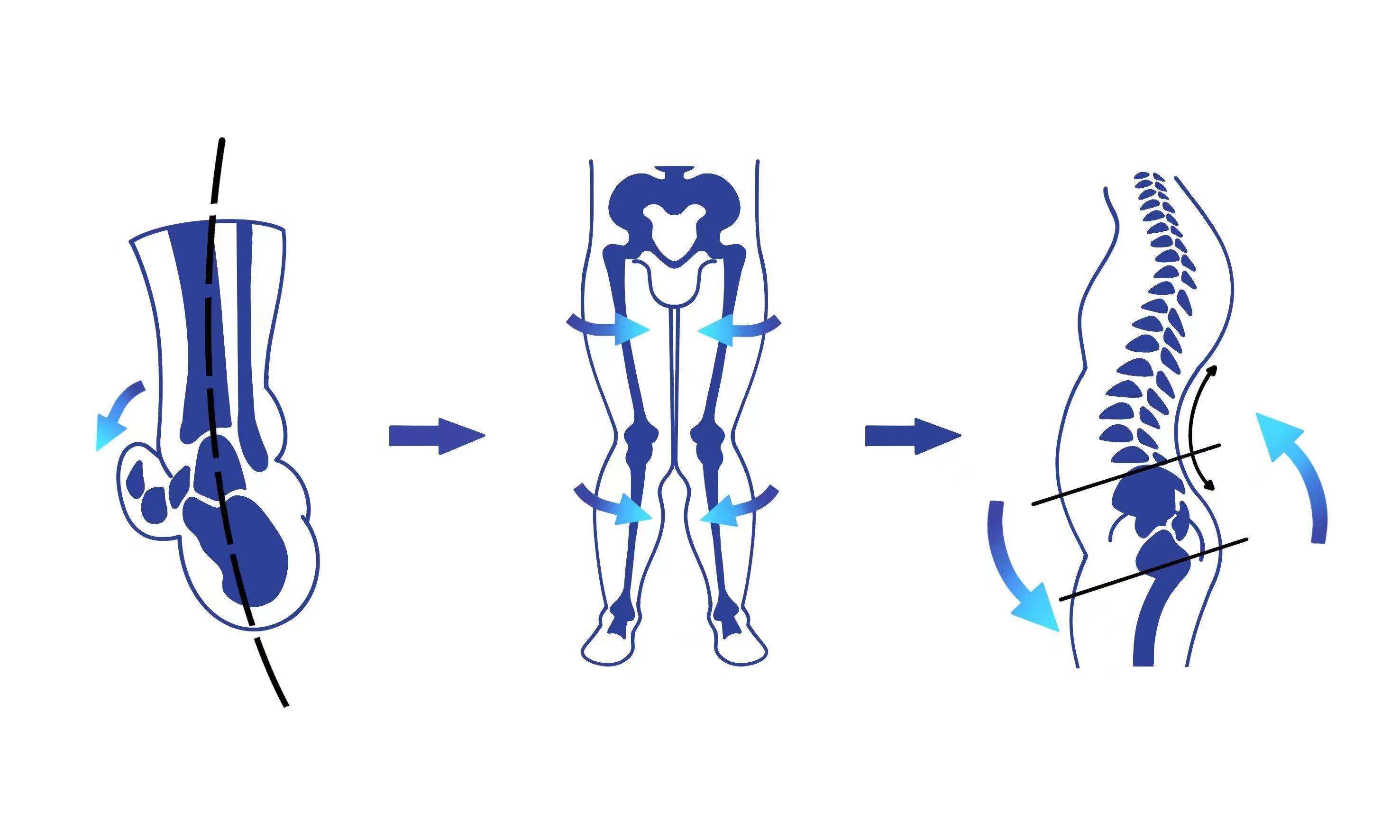 带动距下关节向内偏移,导致上位的胫骨与股骨内旋,出现膝关节的外翻