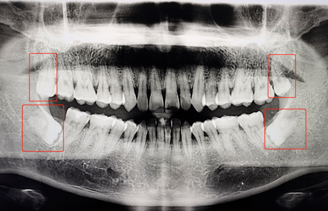 阻生智齿x光片图片