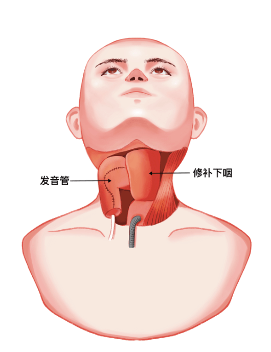 下咽癌手术后图片图片