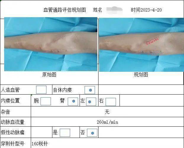 血透绳梯式穿刺法概念图片