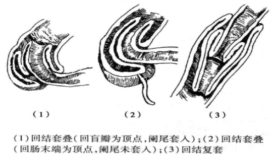 呕吐被误诊为急性胃炎,一查竟是这个凶险病!_肠套叠_患儿_腹部