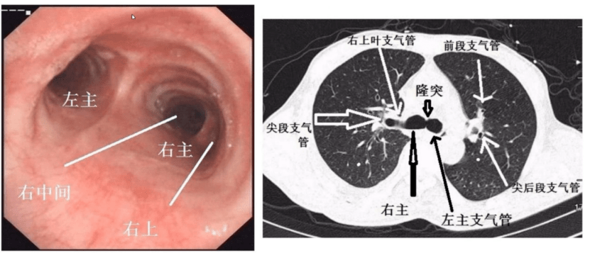 二,支氣管解剖圖:肺部分段ct圖如何進行肺部分段,肺部分段一般常用