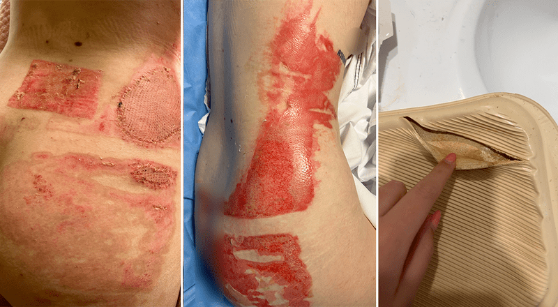 华人常用冬日神器竟爆炸,墨尔本女子腹部被重度烧伤!