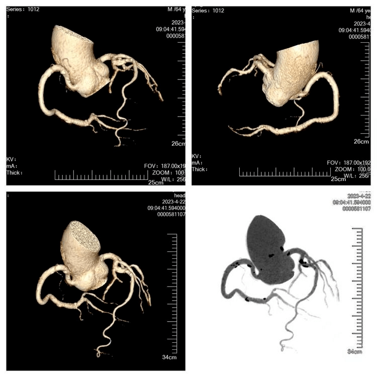 无需屏气,眨眼间完成冠脉扫描——章丘中医院引进新一代双源ct_检查