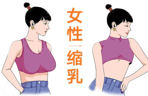 巨乳症是指乳房过度发育,导致乳房体积与躯体比例明显失调.
