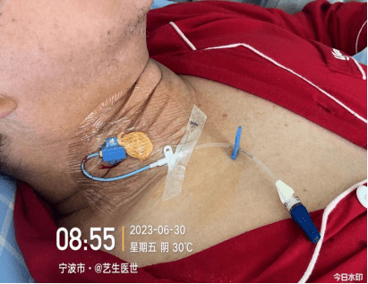 7:45,患者在置管室行颈内静脉穿刺置管术,置管过程欠顺利,第一针穿刺